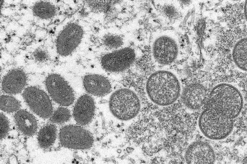 b-c-reports-first-case-of-monkeypox